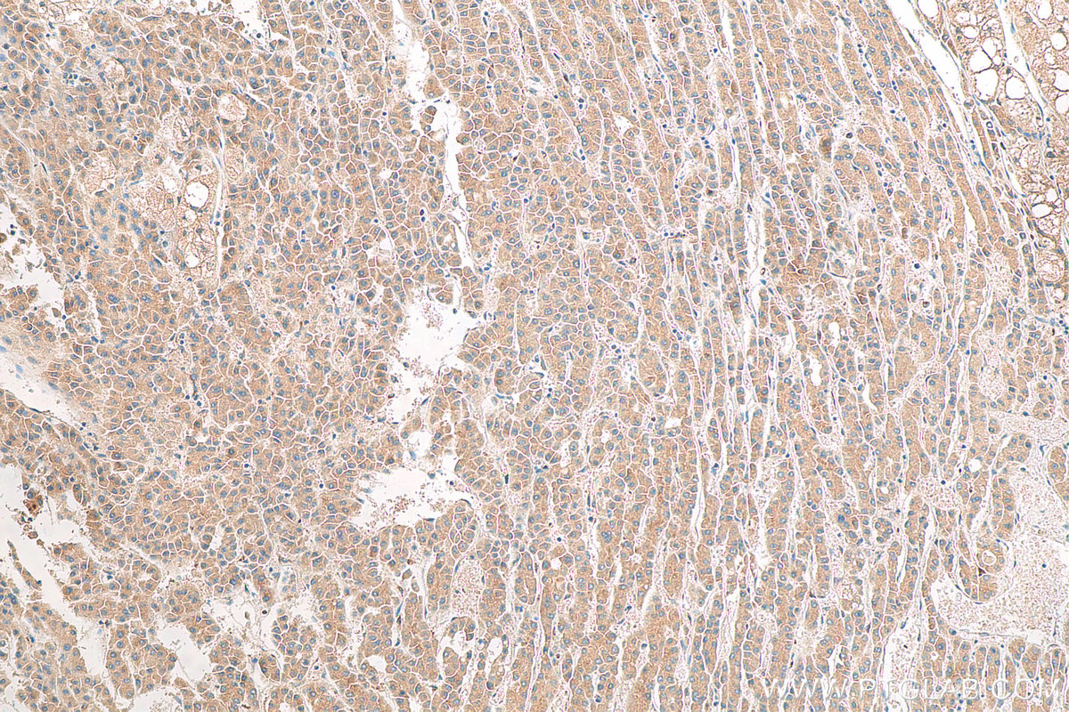 Immunohistochemical analysis of paraffin-embedded human liver cancer tissue slide using 81471-1-RR (FTO antibody) at dilution of 1:1000 (under 10x lens). Heat mediated antigen retrieval with Tris-EDTA buffer (pH 9.0).