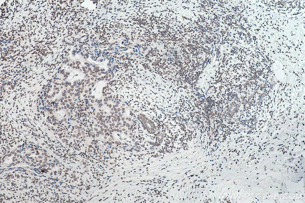 Immunohistochemical analysis of paraffin-embedded human breast cancer tissue slide using 68055-1-Ig (m6A antibody) at dilution of 1:4000 (under 10x lens). Heat mediated antigen retrieval with Tris-EDTA buffer (pH 9.0).