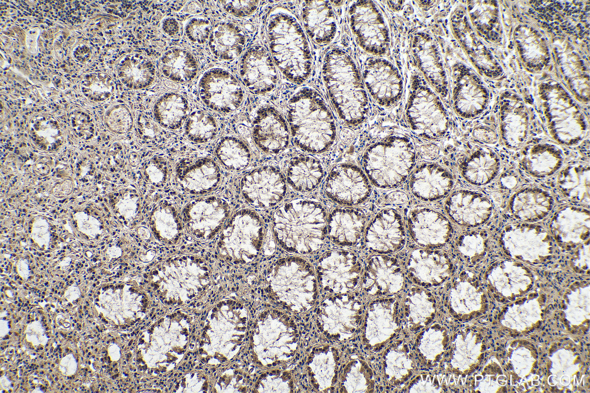 Immunohistochemical analysis of paraffin-embedded human colon cancer tissue slide using 80790-1-RR (METTL14 antibody) at dilution of 1:2000 (under 10x lens). Heat mediated antigen retrieval with Tris-EDTA buffer (pH 9.0).
