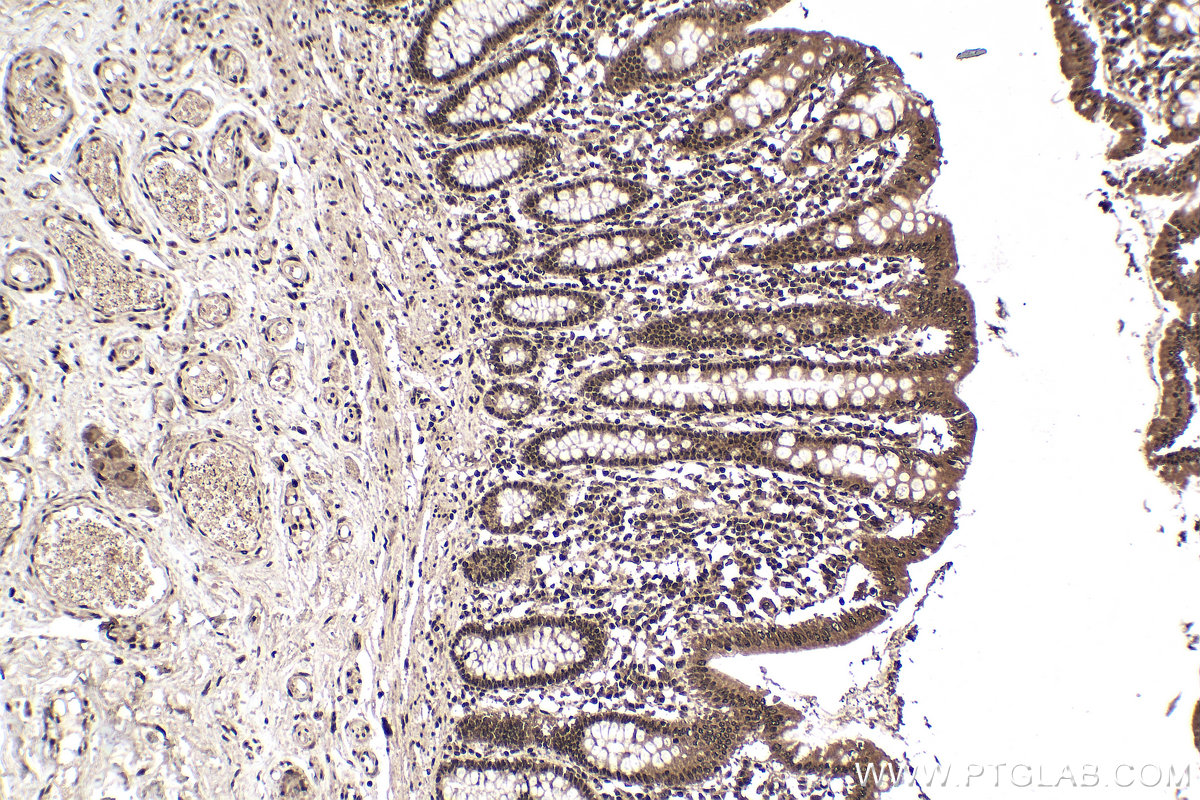 Immunohistochemical analysis of paraffin-embedded human colon tissue slide using 60188-1-Ig (WTAP antibody) at dilution of 1:1000 (under 10x lens). Heat mediated antigen retrieval with Tris-EDTA buffer (pH 9.0).