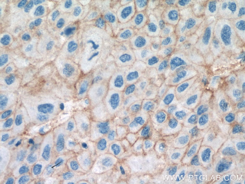 Immunohistochemical analysis of paraffin-embedded human liver cancer tissue slide using 67221-1-Ig (SLC31A1 antibody) at dilution of 1:2000 (under 40x lens). Heat mediated antigen retrieval with Tris-EDTA buffer (pH 9.0).