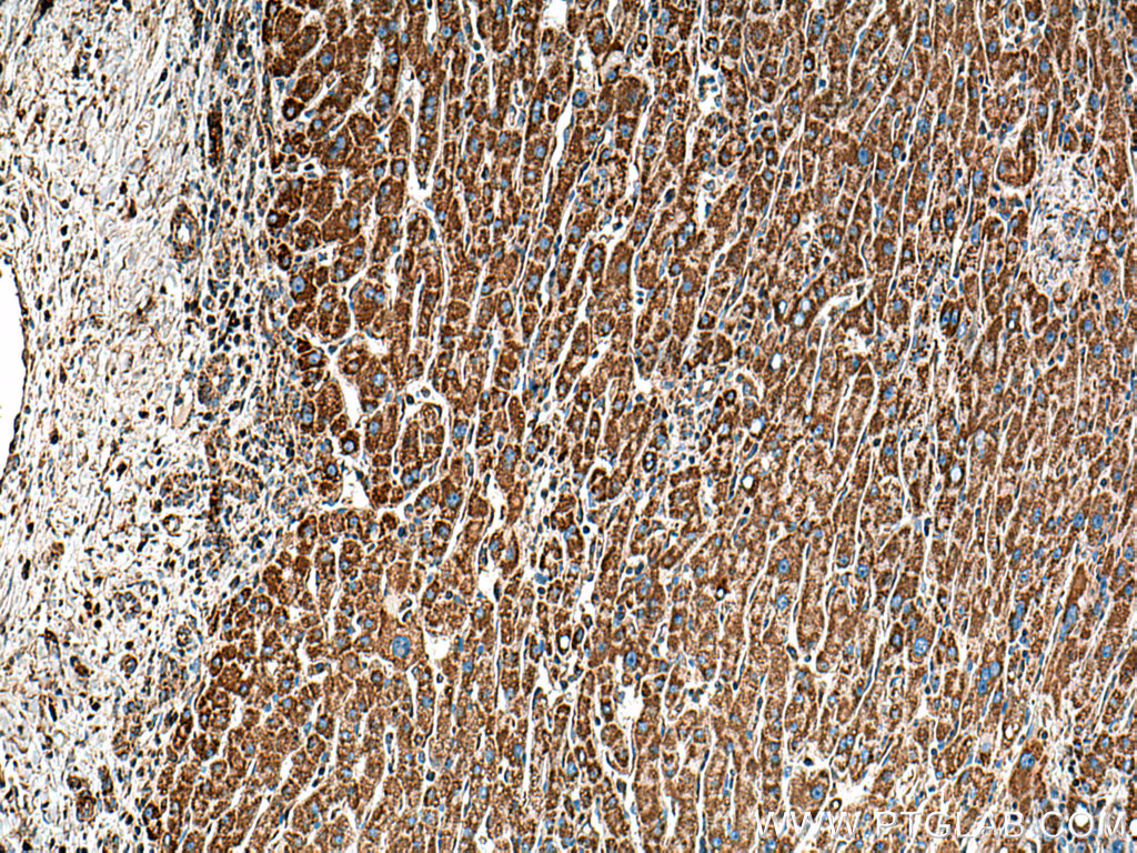 Immunohistochemical analysis of paraffin-embedded human liver cancer tissue slide using 67702-1-Ig (DLD antibody) at dilution of 1:500 (under 10x lens). Heat mediated antigen retrieval with Tris-EDTA buffer (pH 9.0).