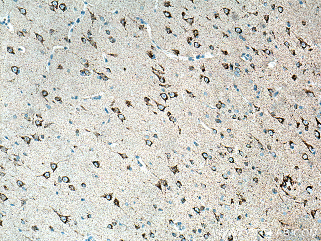Immunohistochemical analysis of paraffin-embedded human gliomas tissue slide using 12855-1-AP (KGA/GAC antibody) at dilution of 1:200 (under 10x lens). Heat mediated antigen retrieval with Tris-EDTA buffer (pH 9.0).