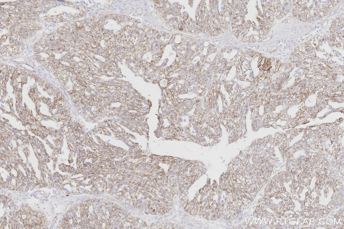 Immunohistochemical analysis of paraffin-embedded human ovary cancer tissue slide using 66379-1-Ig (Beta Catenin antibody) at dilution of 1:5000. Multi-rAb® Biotin-Goat Anti-Mouse Recombinant Secondary Antibody (H+L) was used at 6.5 ug/mL for signal amplification. HRP conjugated streptavidin was used for detection. Immunohistochemical analysis of paraffin-embedded human ovary cancer tissue slide using 66379-1-Ig (Beta Catenin antibody) at dilution of 1:5000. Multi-rAb® Biotin-Goat Anti-Mouse Recombinant Secondary Antibody (H+L) was used at 6.5 ug/mL for signal amplification. HRP conjugated streptavidin was used for detection.