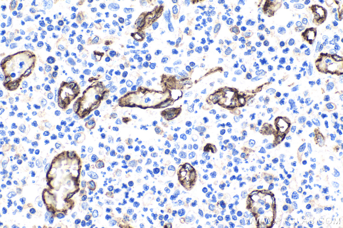 Immunohistochemical analysis of paraffin-embedded human colon cancer tissue slide using 66065-2-Ig (CD31 mouse monoclonal antibody) at dilution of 1:10000 . Heat mediated antigen retrieval with Tris-EDTA buffer (pH 9.0). Multi-rAb™ Polymer HRP-Goat anti-mouse Recombinant secondary antibody RGAM011 was used for detection.