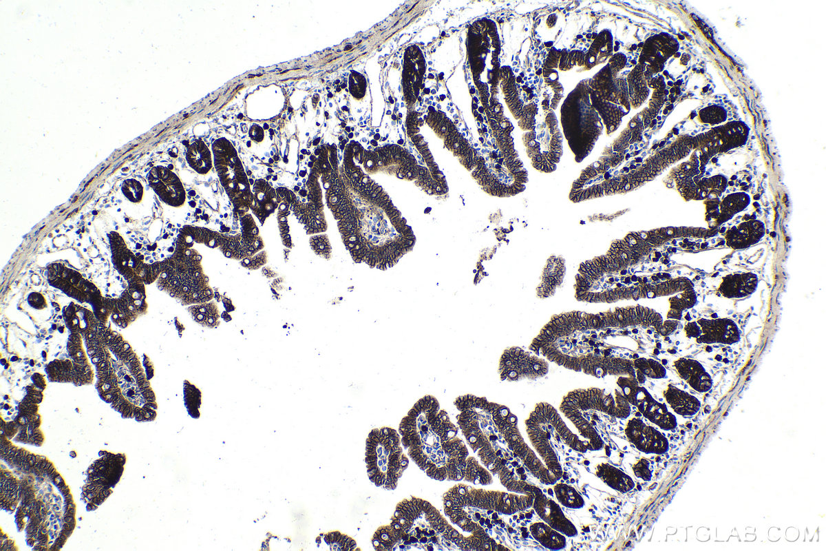 Immunohistochemical analysis of paraffin-embedded human colon cancer tissue slide using 66379-1-Ig (Beta Catenin mouse monoclonal antibody) at dilution of 1:20000 . Heat mediated antigen retrieval with Tris-EDTA buffer (pH 9.0). Multi-rAb™ Polymer HRP-Goat anti-mouse Recombinant secondary antibody RGAM011 was used for detection.