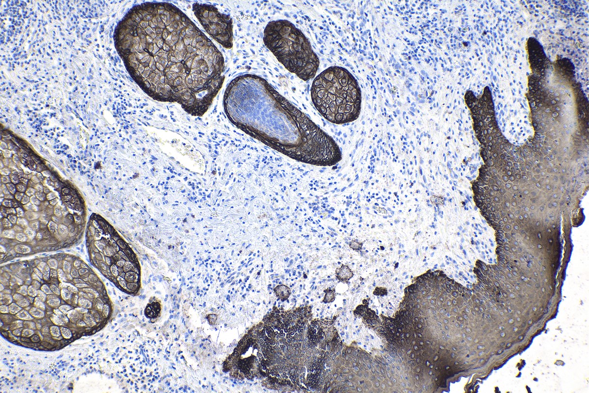 Immunohistochemical analysis of paraffin-embedded human skin cancer tissue slide using commercial IVD grade pan-CK mouse monoclonal antibody. Heat mediated antigen retrieval with Tris-EDTA buffer (pH 9.0). Multi-rAb™ Polymer HRP-Goat anti-mouse Recombinant secondary antibody RGAM011 was used for detection.