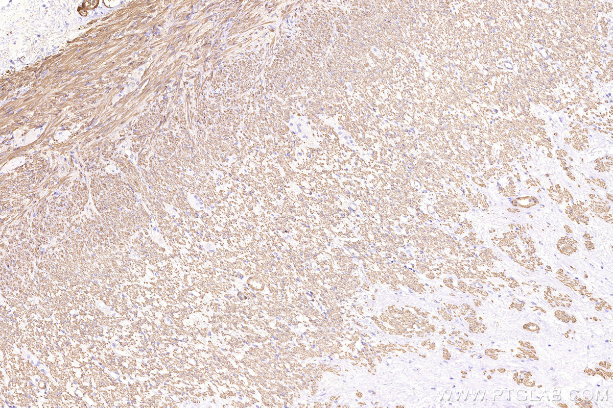 Immunohistochemical analysis of paraffin-embedded human appendicitis tissue slide using 80008-1-RR (Alpha smooth muscle actin specific antibody) at dilution of 1:10000. Multi-rAb® Biotin-Goat Anti-Rabbit Recombinant Secondary Antibody (H+L) was used at 4 ug/mL for signal amplification. HRP conjugated streptavidin was used for detection. Immunohistochemical analysis of paraffin-embedded human appendicitis tissue slide using 80008-1-RR (Alpha smooth muscle actin specific antibody) at dilution of 1:10000. Multi-rAb® Biotin-Goat Anti-Rabbit Recombinant Secondary Antibody (H+L) was used at 4 ug/mL for signal amplification. HRP conjugated streptavidin was used for detection.