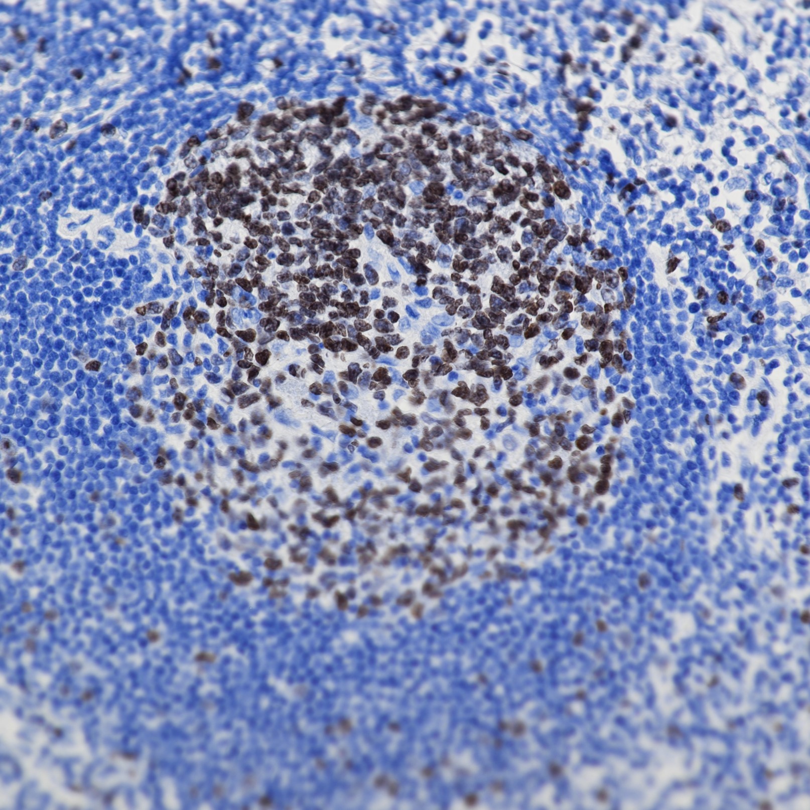 Immunohistochemical analysis of paraffin-embedded human tonsillitis tissue slide using commercial IVD grade KI67 antibody. Heat mediated antigen retrieval with Tris-EDTA buffer (pH 9.0). Multi-rAb™ Polymer HRP-Goat anti-rabbit Recombinant secondary antibody RGAR011 was used for detection.