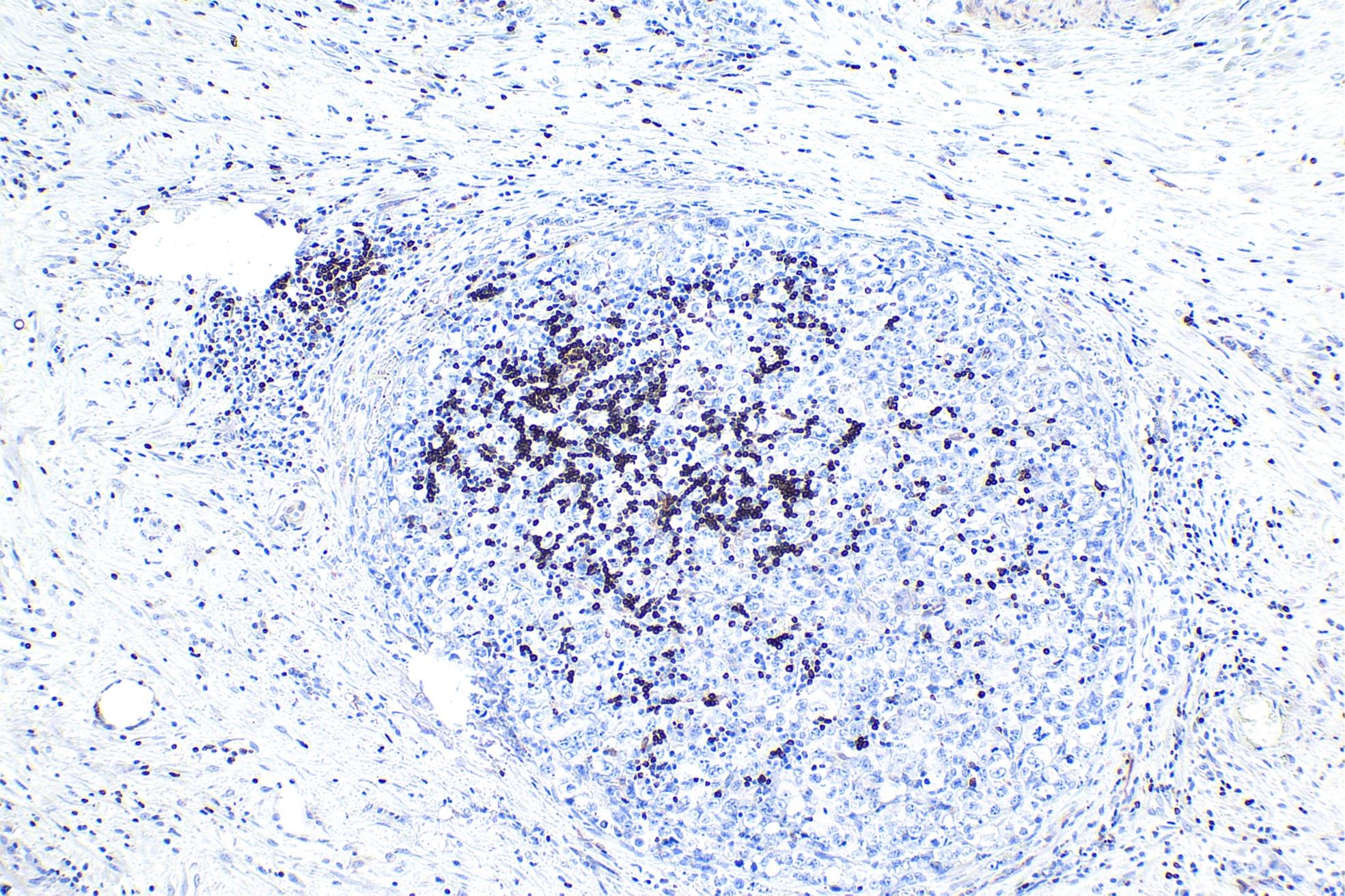 Immunohistochemical analysis of paraffin-embedded human lymphoma tissue slide using other vendor's BCL2 rabbit recombinant antibody. Heat mediated antigen retrieval with Tris-EDTA buffer (pH 9.0). Multi-rAb™ Polymer HRP-Goat anti-rabbit Recombinant secondary antibody RGAR011 was used for detection.