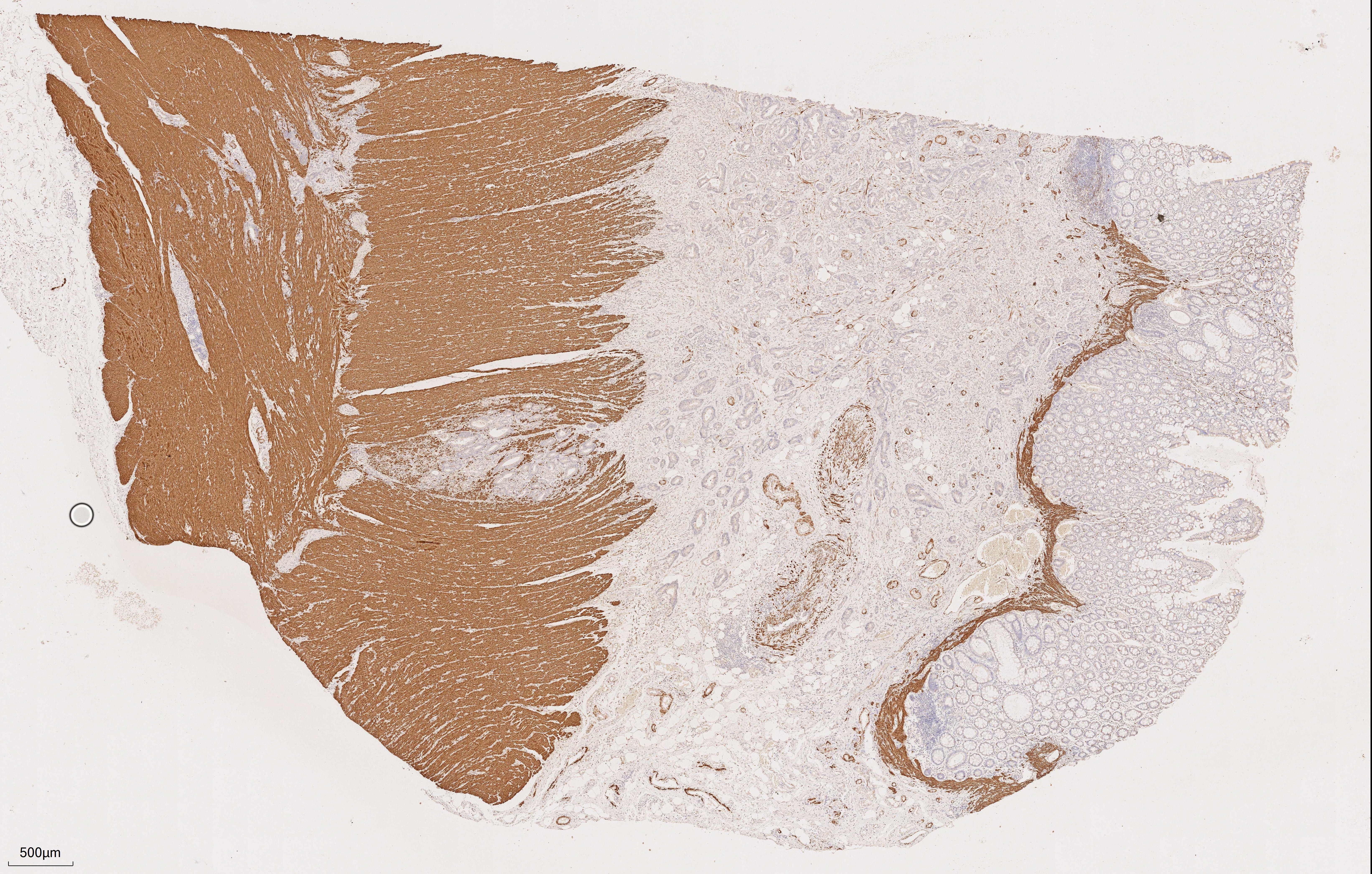 Immunohistochemical analysis of paraffin-embedded human rectal cancer tissue slide using 67793-1-Ig (Desmin mouse monoclonal antibody) at dilution of 1:2000. Heat mediated antigen retrieval with Tris-EDTA buffer (pH 9.0). Multi-rAb™ Enhanced Anti-Rabbit/Mouse Universal Secondary System Plus  RGAU015 was used for detection.