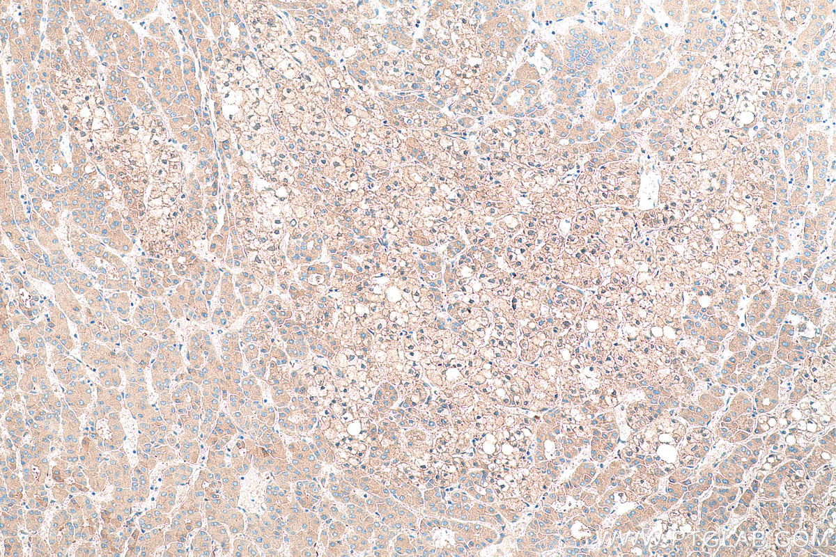 Immunohistochemical analysis of paraffin-embedded human liver cancer tissue slide using KHC0378 (A2M IHC Kit).