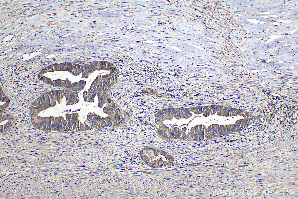 Immunohistochemical analysis of paraffin-embedded human pancreas cancer tissue slide using KHC1096 (ABCA3 IHC Kit).