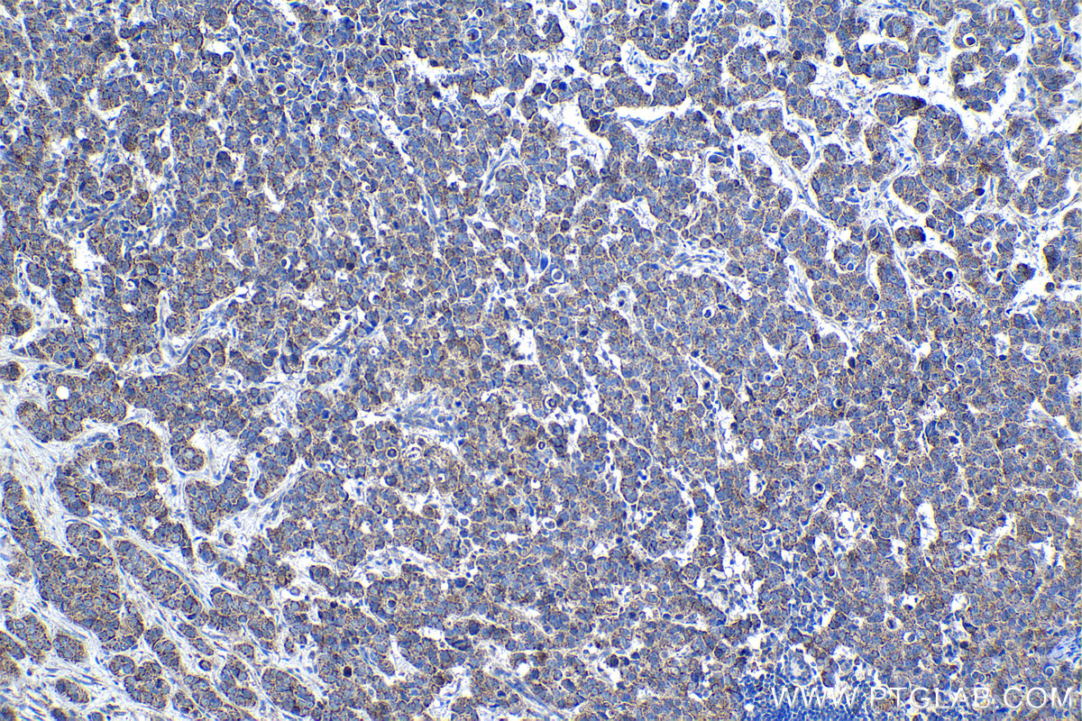 Immunohistochemical analysis of paraffin-embedded human breast cancer tissue slide using KHC1348 (ABCB9 IHC Kit).