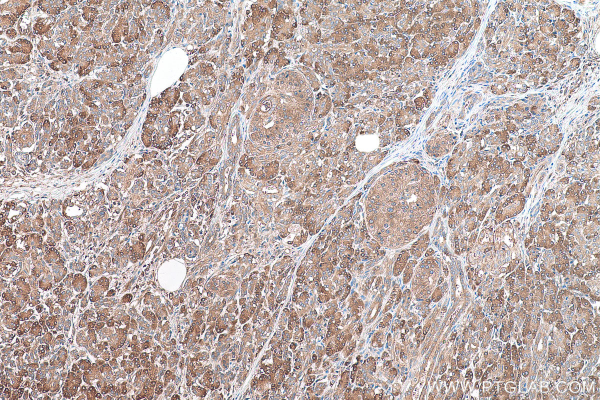 Immunohistochemical analysis of paraffin-embedded human pancreas cancer tissue slide using KHC0909 (ABCE1 IHC Kit).