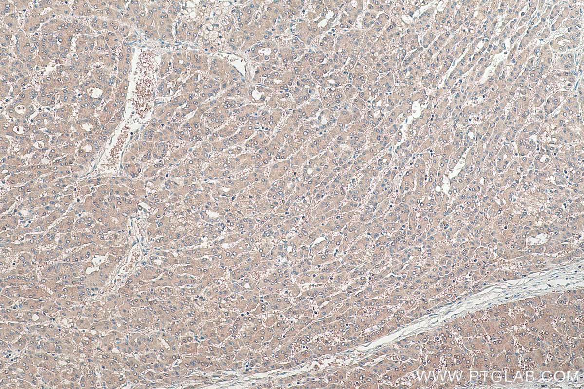 Immunohistochemical analysis of paraffin-embedded human liver cancer tissue slide using KHC0392 (ABHD14B IHC Kit).