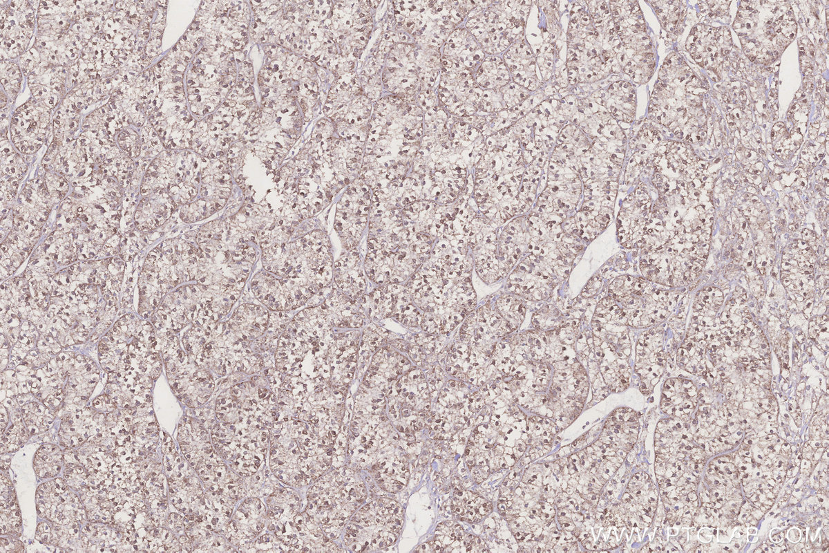 Immunohistochemical analysis of paraffin-embedded human renal cell carcinoma tissue slide using KHC3205 (ACADL IHC Kit).