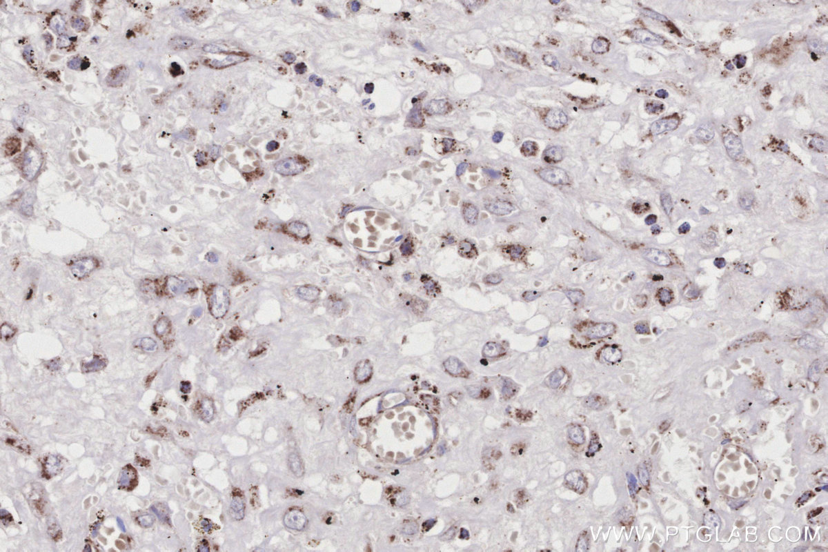Immunohistochemical analysis of paraffin-embedded human colon cancer tissue slide using KHC3189 (ACADS IHC Kit).