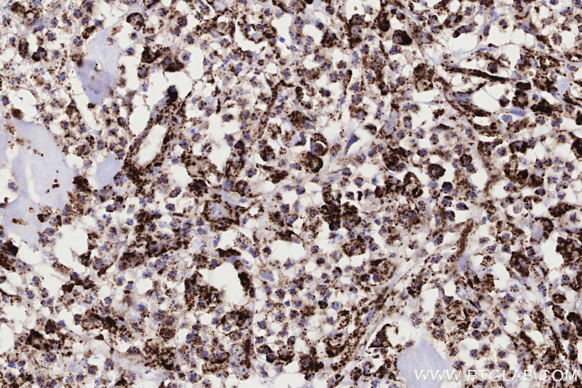 Immunohistochemical analysis of paraffin-embedded human colon cancer tissue slide using KHC3218 (ACADVL IHC Kit).