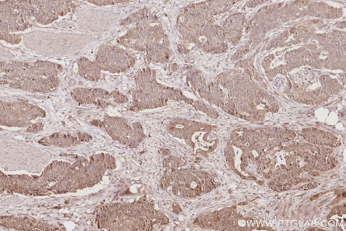Immunohistochemical analysis of paraffin-embedded human stomach cancer tissue slide using KHC2910 (ACBD3 IHC Kit).