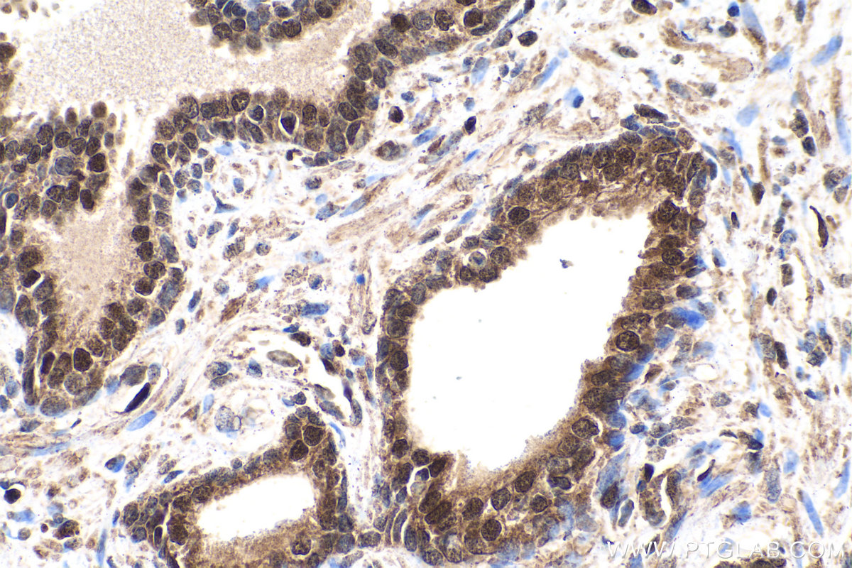 Immunohistochemical analysis of paraffin-embedded human prostate cancer tissue slide using KHC0227 (ACLY IHC Kit).