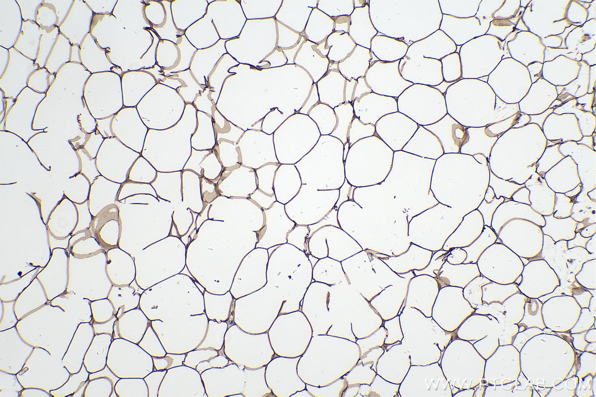 Immunohistochemical analysis of paraffin-embedded human breast cancer tissue slide using KHC0227 (ACLY IHC Kit).