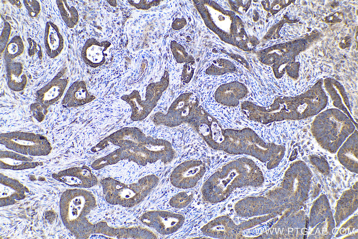 Immunohistochemical analysis of paraffin-embedded human colon cancer tissue slide using KHC0878 (ACOT13/THEM2 IHC Kit).