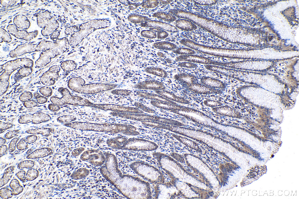 Immunohistochemical analysis of paraffin-embedded human stomach cancer tissue slide using KHC1038 (ACOT9 IHC Kit).