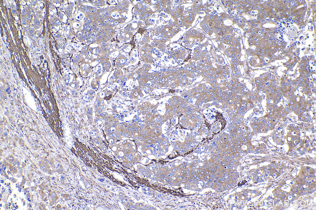 Immunohistochemical analysis of paraffin-embedded human stomach cancer tissue slide using KHC2338 (ACTR1A IHC Kit).