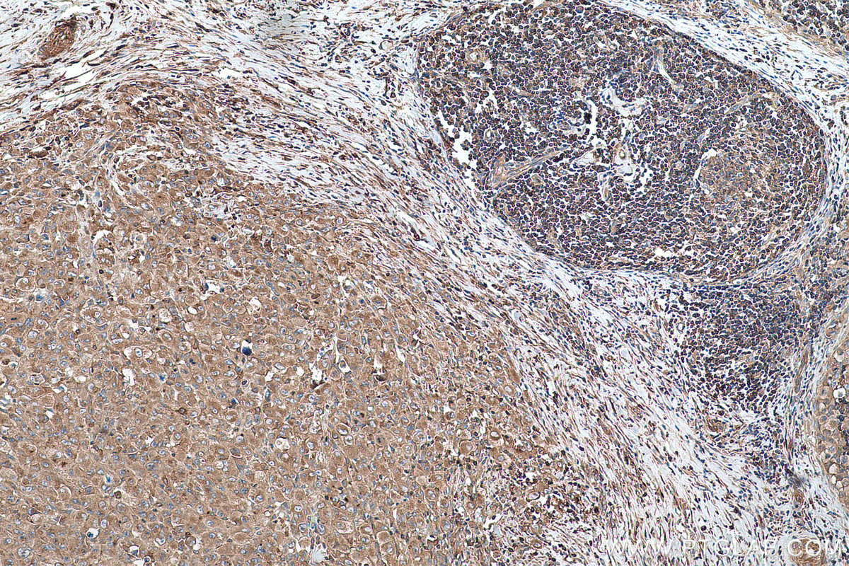 Immunohistochemical analysis of paraffin-embedded human lymphoma tissue slide using KHC0728 (ACTR2 IHC Kit).