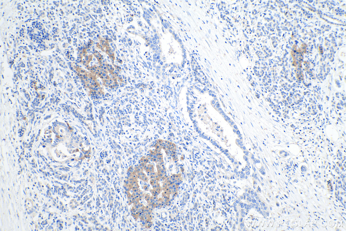 Immunohistochemical analysis of paraffin-embedded human pancreas cancer tissue slide using KHC0241 (ACVR1C/ALK7 IHC Kit).