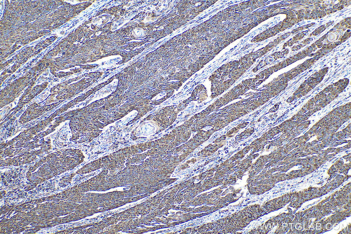 Immunohistochemical analysis of paraffin-embedded human oesophagus cancer tissue slide using KHC0499 (ADH1B IHC Kit).