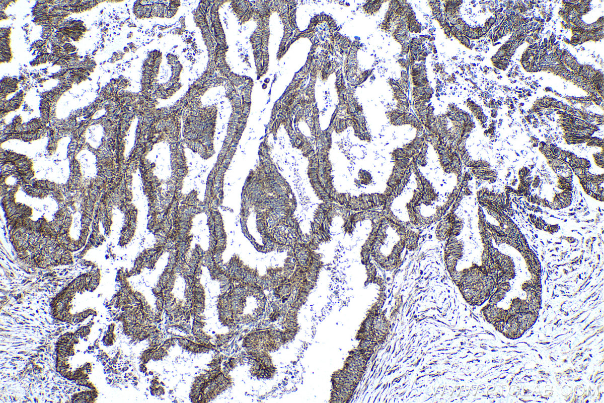 Immunohistochemical analysis of paraffin-embedded human ovary tumor tissue slide using KHC0499 (ADH1B IHC Kit).