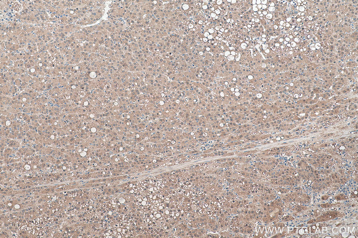 Immunohistochemical analysis of paraffin-embedded human liver cancer tissue slide using KHC0539 (ADH6 IHC Kit).