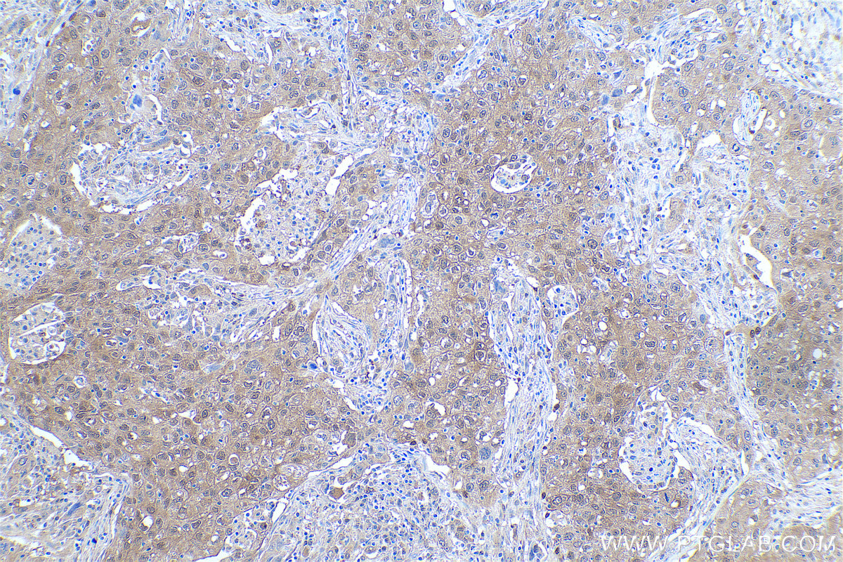 Immunohistochemical analysis of paraffin-embedded human lung cancer tissue slide using KHC0916 (ADI1 IHC Kit).