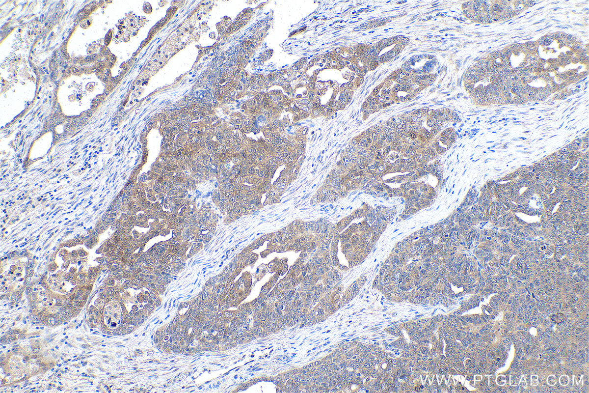 Immunohistochemical analysis of paraffin-embedded human ovary tumor tissue slide using KHC0916 (ADI1 IHC Kit).