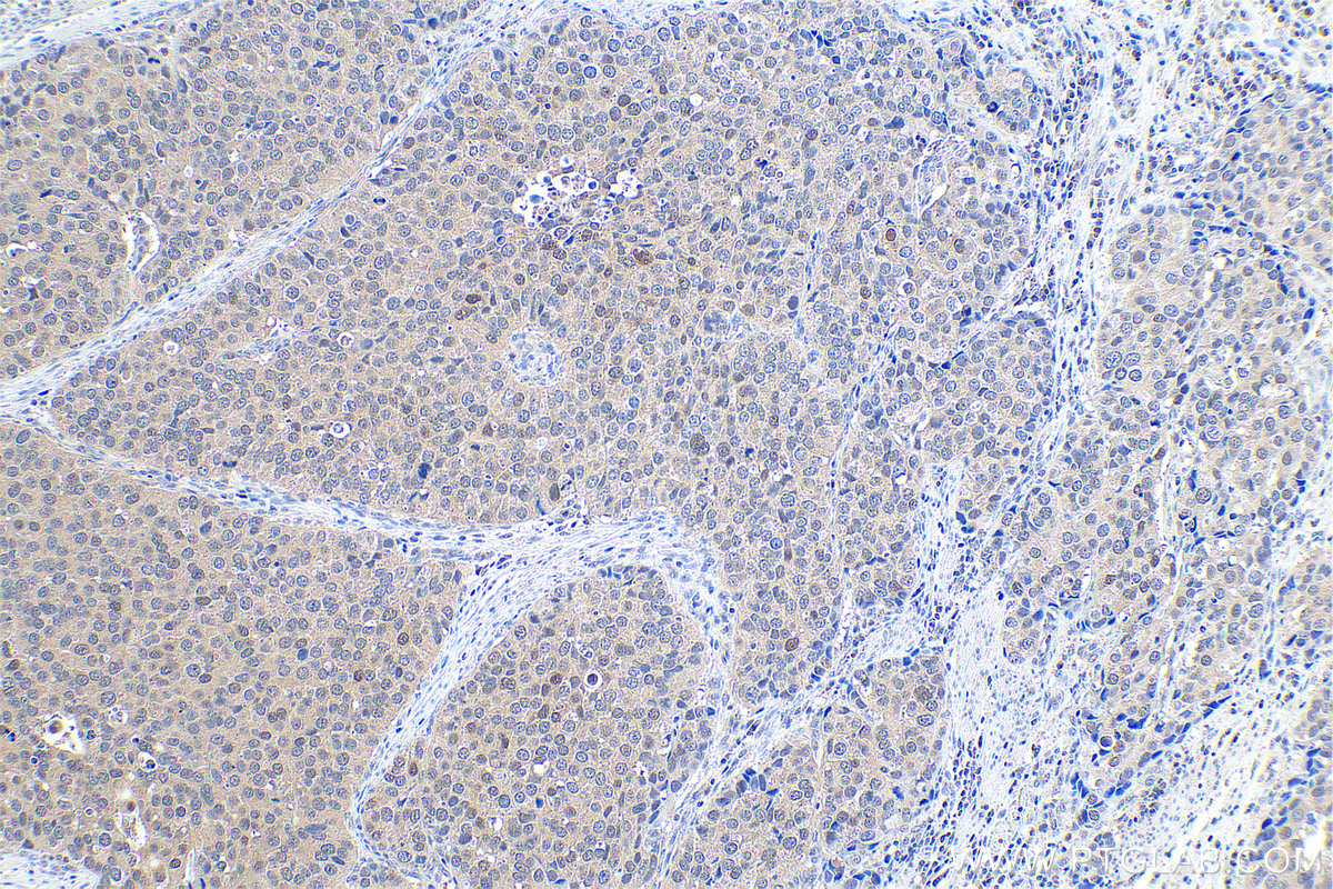 Immunohistochemical analysis of paraffin-embedded human stomach cancer tissue slide using KHC0916 (ADI1 IHC Kit).