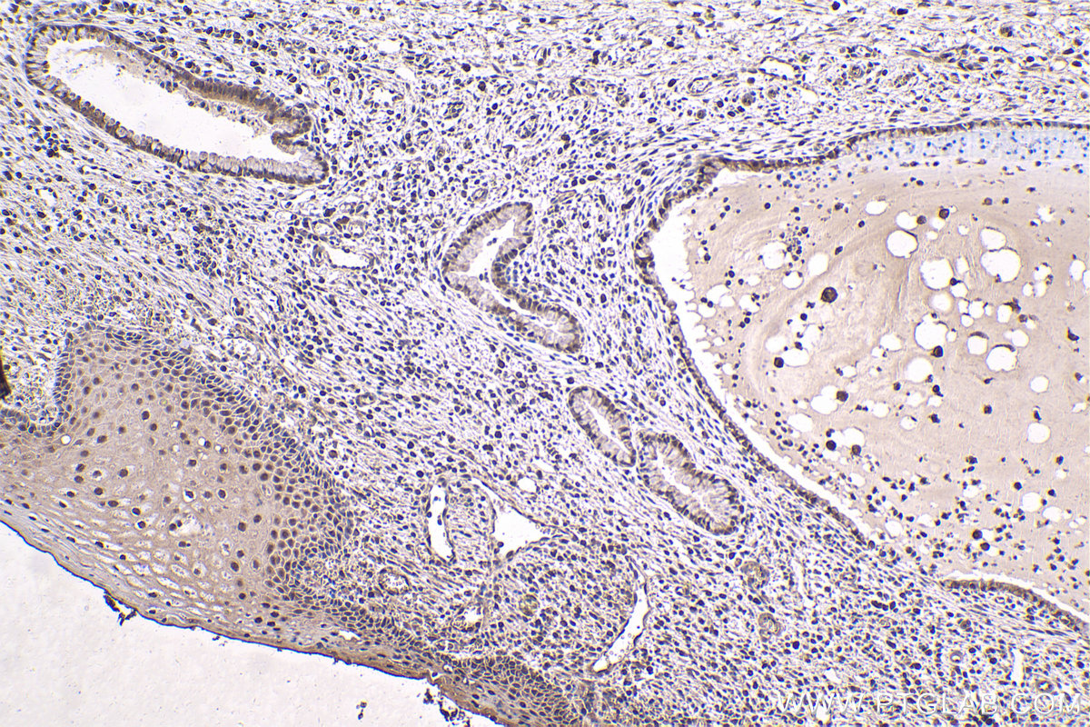 Immunohistochemical analysis of paraffin-embedded human cervical cancer tissue slide using KHC1757 (ADRM1 IHC Kit).