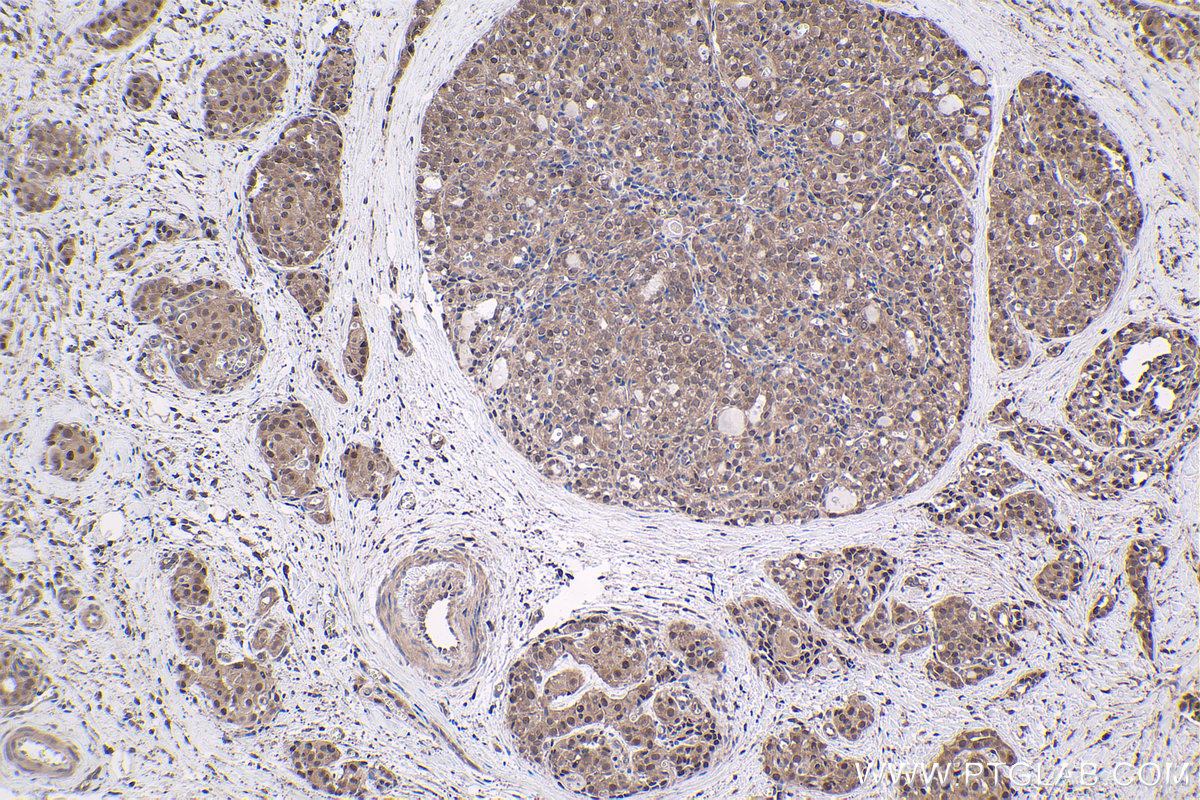 Immunohistochemical analysis of paraffin-embedded human thyroid cancer tissue slide using KHC1757 (ADRM1 IHC Kit).