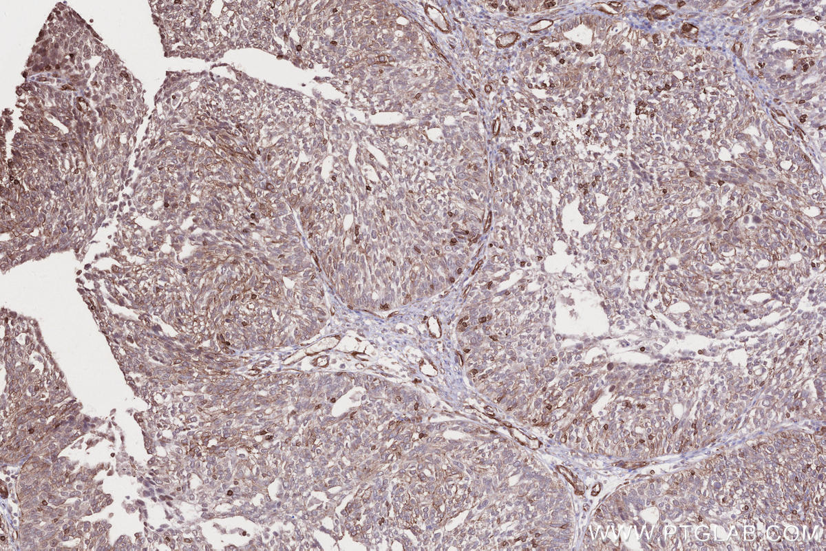 Immunohistochemical analysis of paraffin-embedded human ovary cancer tissue slide using KHC2676 (AFAP1L2 IHC Kit).