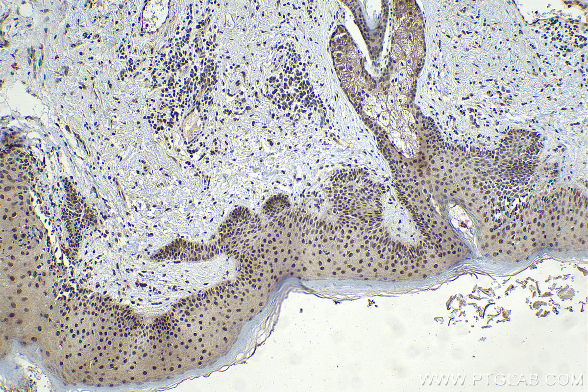 Immunohistochemical analysis of paraffin-embedded human skin cancer tissue slide using KHC1982 (AFF4 IHC Kit).