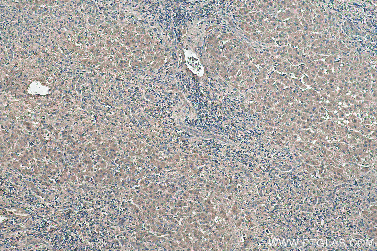 Immunohistochemical analysis of paraffin-embedded human liver cancer tissue slide using KHC0380 (AFP IHC Kit).