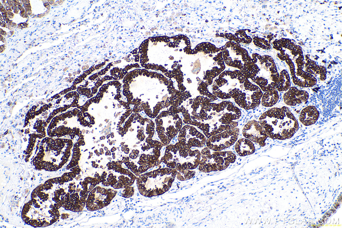 Immunohistochemical analysis of paraffin-embedded human lung cancer tissue slide using KHC0653 (AGR2 IHC Kit).