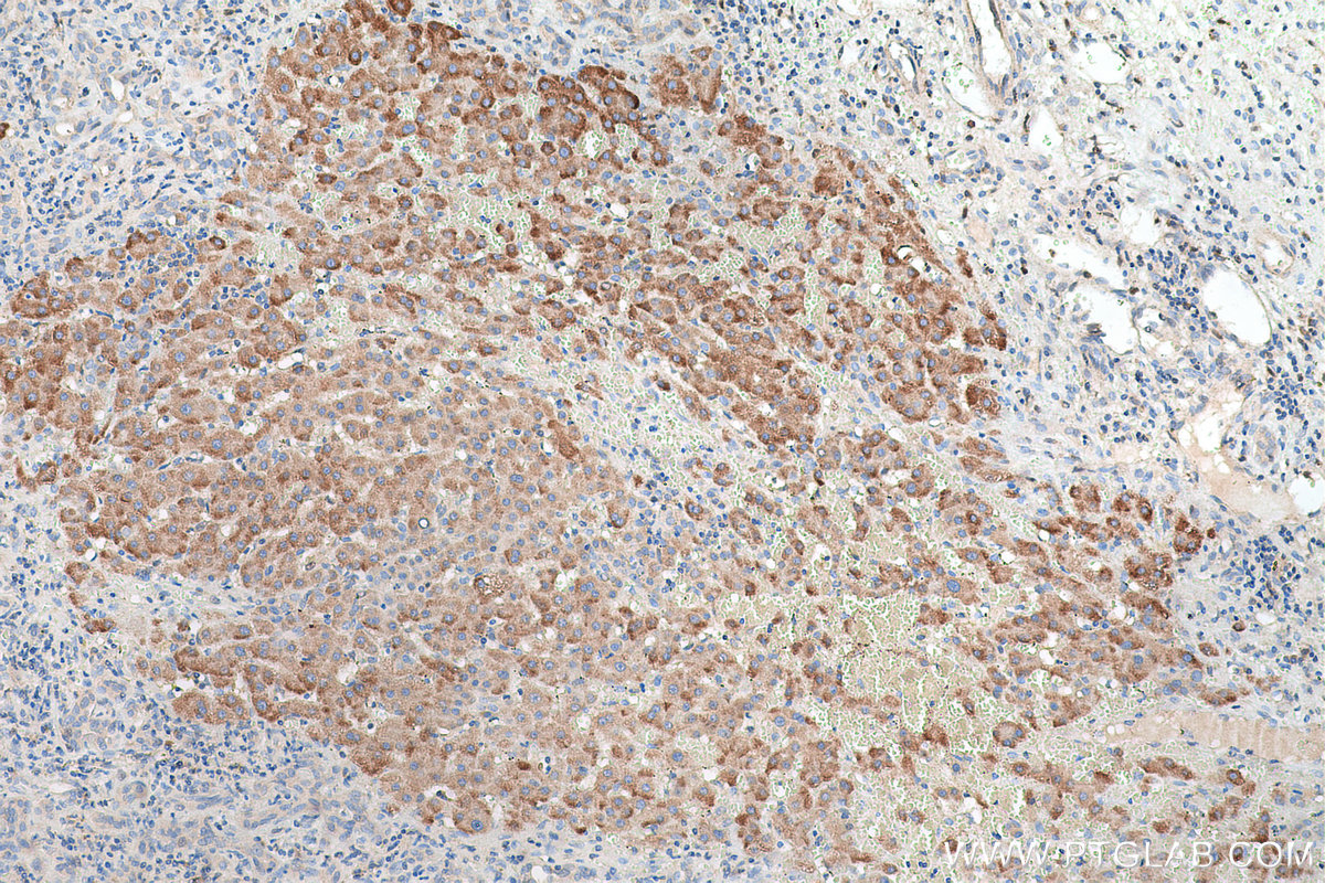 Immunohistochemical analysis of paraffin-embedded human liver cancer tissue slide using KHC0693 (AGR3 IHC Kit).