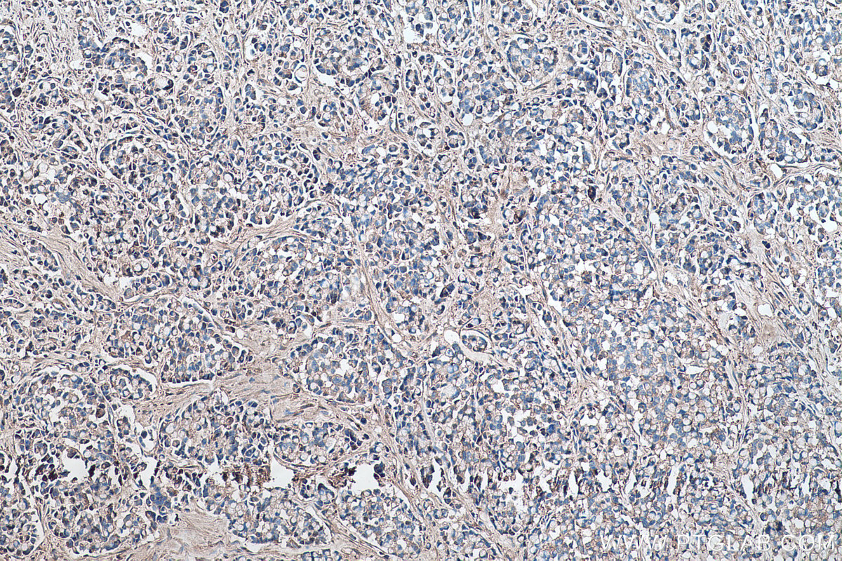 Immunohistochemical analysis of paraffin-embedded human colon cancer tissue slide using KHC0490 (AGT IHC Kit).