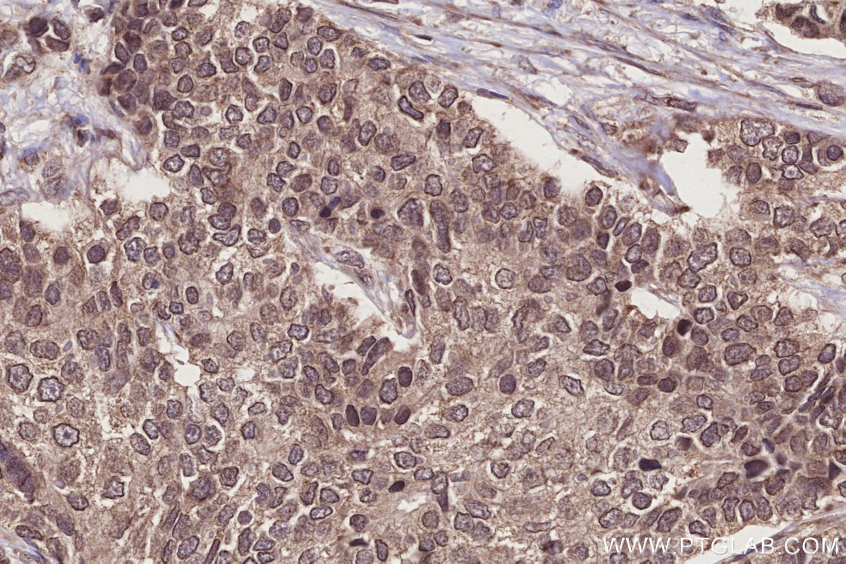 Immunohistochemical analysis of paraffin-embedded human stomach cancer tissue slide using KHC2744 (AHCTF1 IHC Kit). Immunohistochemical analysis of paraffin-embedded human stomach cancer tissue slide using KHC2744 (AHCTF1 IHC Kit).
