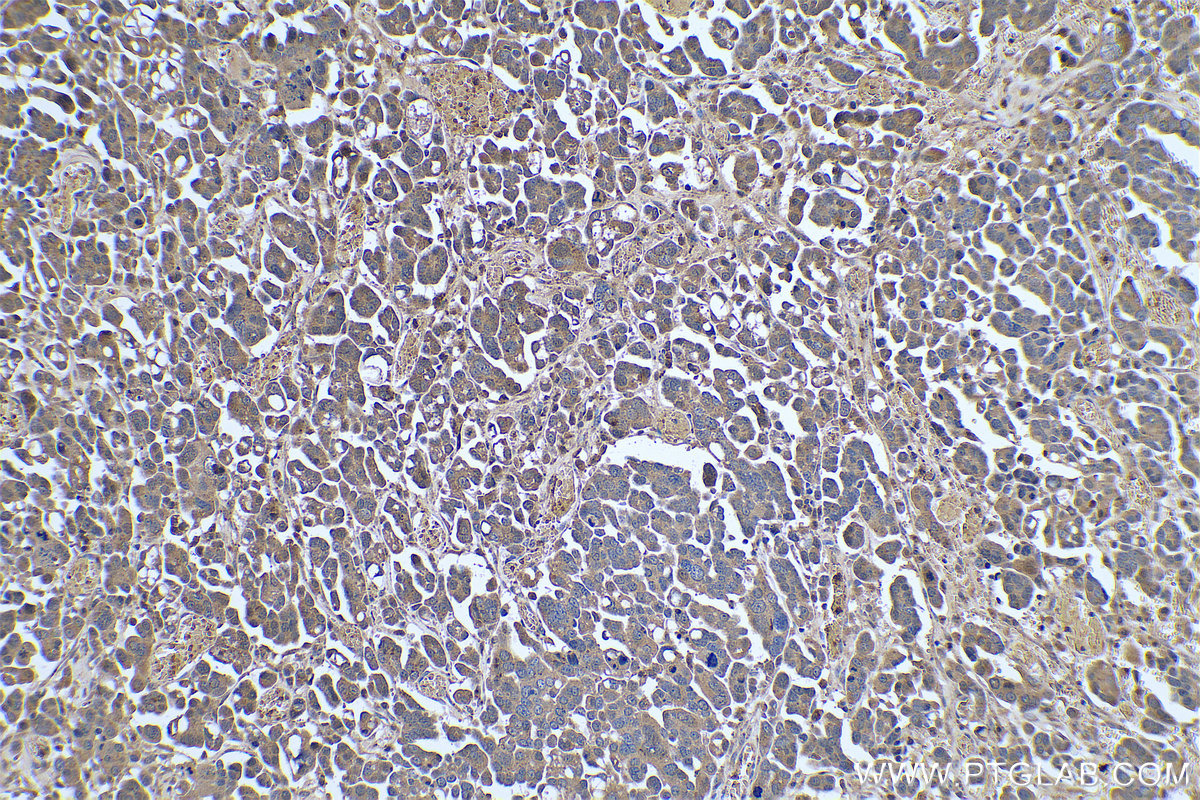 Immunohistochemical analysis of paraffin-embedded human colon cancer tissue slide using KHC0776 (AHCY IHC Kit).