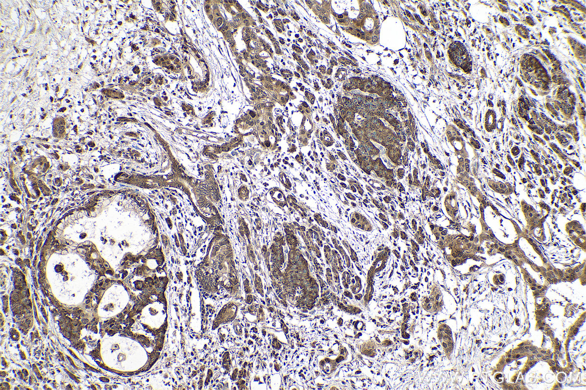 Immunohistochemical analysis of paraffin-embedded human pancreas cancer tissue slide using KHC0776 (AHCY IHC Kit).