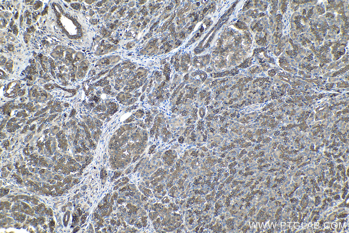 Immunohistochemical analysis of paraffin-embedded human pancreas cancer tissue slide using KHC0976 (AHCYL1 IHC Kit).