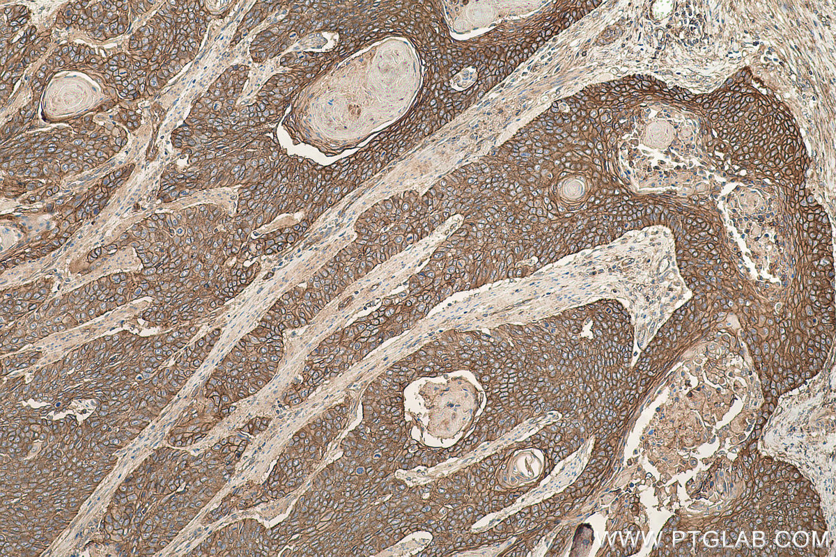 Immunohistochemical analysis of paraffin-embedded human oesophagus cancer tissue slide using KHC0658 (AHNAK IHC Kit).